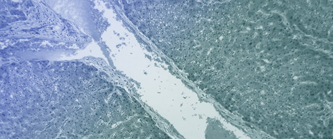 NHE1-Mediated Metabolic Reprogramming in Cancer