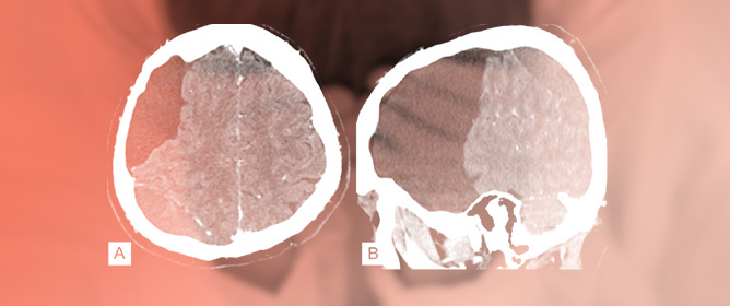 Diagnostic and Therapeutic Pitfalls Encountered in a Young Adult Patient with a Symptomatic Chronic Subdural Hematoma Mimicking a Subacute Epidural Hematoma in the Presence of a Galassi Grade III Arachnoid Cyst: Case Report