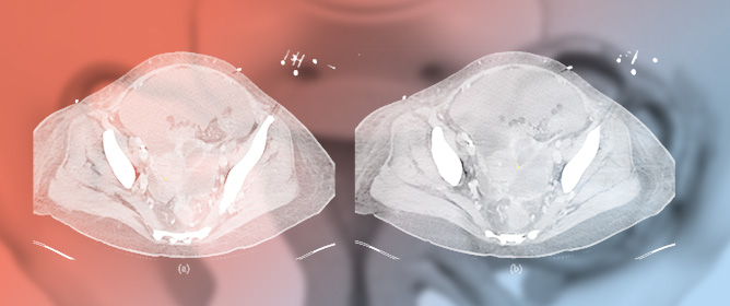 Bilateral Tubo-Ovarian Abscesses Associated with Enterococcal Translocation in Decompensated Cirrhosis: A Case Report