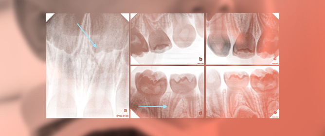 <em>Dentinogenesis Imperfecta</em> in Primary Dentition: Case Report