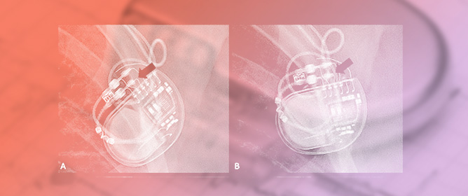 When Pacing Fails After Generator Replacement: A Stepwise Diagnostic Approach to a Reversible Lead&ndash;Header Interface Problem
