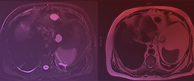 Pedunculated Hepatic Hemangioma Arising from the Left Triangular Ligament: MRI as the Key Modality for Noninvasive Diagnosis&mdash;Case Report and Literature Review