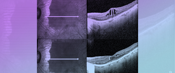 Bromelain and Curcumin Oral Supplementation for Refractory Inherited Retinal Dystrophy-Related Macular Oedema: Changes in Macular Thickness and Visual Acuity over 12 Months