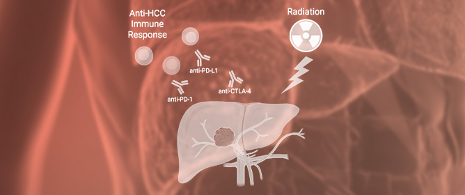 Combining External Beam Radiotherapy and Immunotherapy for the Treatment of Hepatocellular Carcinoma