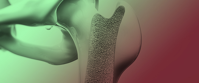 Fracture Risk Assessment in People with Osteoporosis/Osteopenia with Urine NTx (Urinary N-Terminal Telopeptides): An Exploratory Retrospective Study