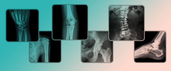 Overlap of Gout and Calcium Pyrophosphate Deposition with Osteoarthritis, Rheumatoid Arthritis, and Psoriatic Arthritis: Epidemiology, Clinical-Radiological Profiles, Outcomes, and Management