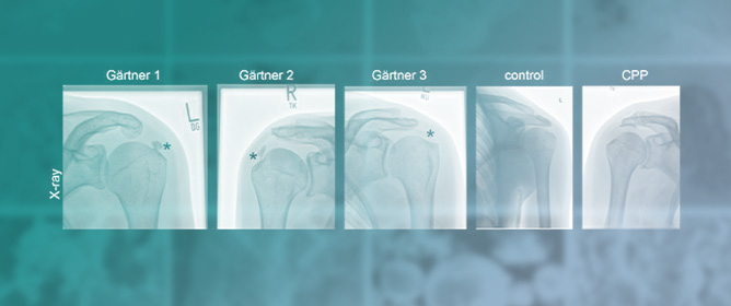 Calcific Tendinitis Is Mainly Associated with Basic Calcium Phosphate Deposition, but Rare Cases of Calcium Pyrophosphate Can Occur