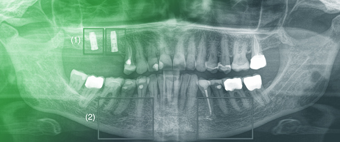 AI-Based Osteoporosis Detection on Dental Radiographs
