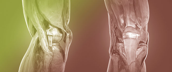 Patellar Maltracking in Total Knee Arthroplasty: Mechanisms, Prevention and Treatment
