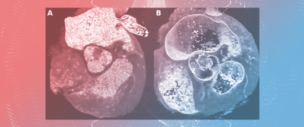 4D Cinematic Rendering for Cardiac Valve Mass Assessment