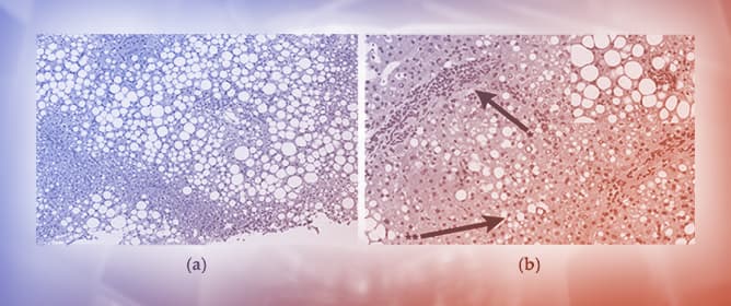 A New Ultrasound Method to Study the Relations Between Ileocecal Valve Incontinence and Inflammation in Metabolic Associated Steatotic Liver Disease
