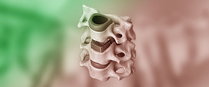 Spine Interbody Fusion Cages: Concepts, Design Trends, and Emerging Personalized Solutions