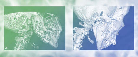 Accuracy and Safety of Computer-Assisted Surgery (CAS) in the Treatment of TMJ Ankylosis&mdash;Report of Several Cases and Review of the Literature
