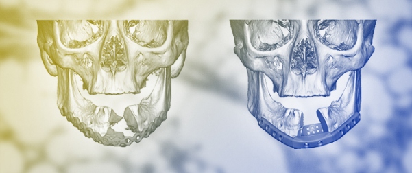 Innovations in Clinical Maxillofacial Tissue Engineering and Reconstruction: Cellular Bone Matrix Allografts, Autografts, and Growth Factors