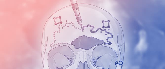 Current Concepts in Frontal Sinus Fracture Management