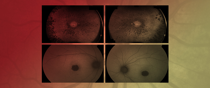 Dissecting PDE6-Associated Inherited Retinal Dystrophies Using Patient-Derived Retinal Models