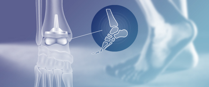 Revision After Total Ankle Arthroplasty: A Cross-Registry Analysis