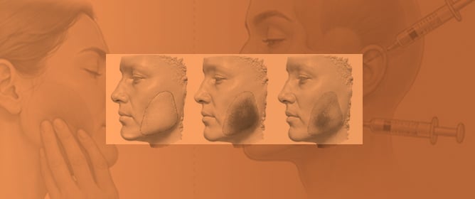 Masseter Muscle Morphometric Changes After Botulinum Toxin Type A Injection: A Prospective 3-Month Study