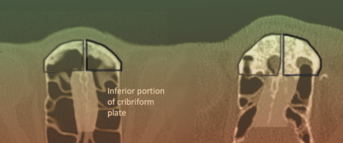 Development and Validation of a Systematic and Reliable Computed Tomography Measurement Method for Ethmoid Sinus and Frontal Recess Dimensions in Chronic Rhinosinusitis
