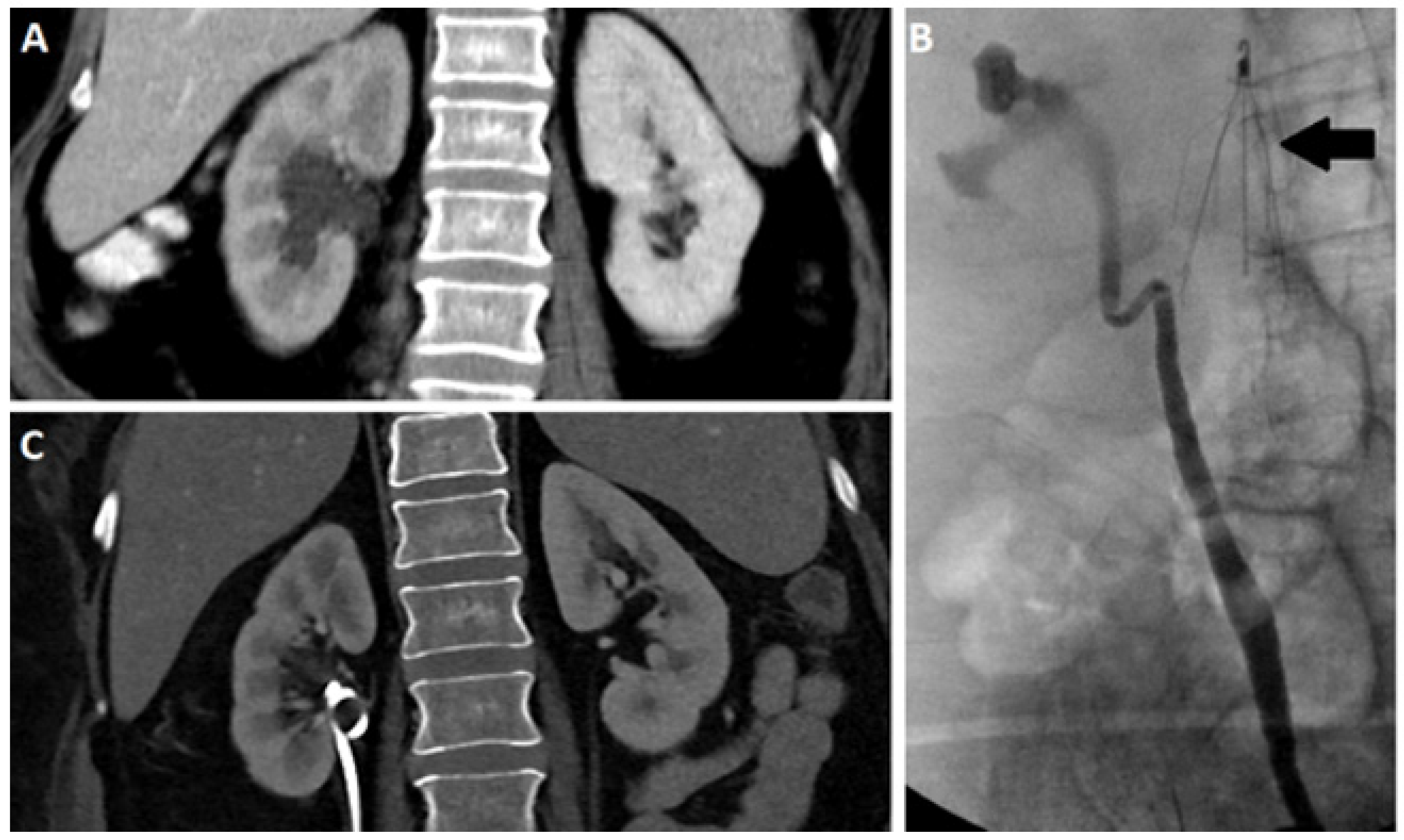 Tomography | Full-Text | Dynamic Contrast Enhanced-MR Urography: An Emerging Tool in the Diagnosis and Management of Upper Urinary Tract Obstruction