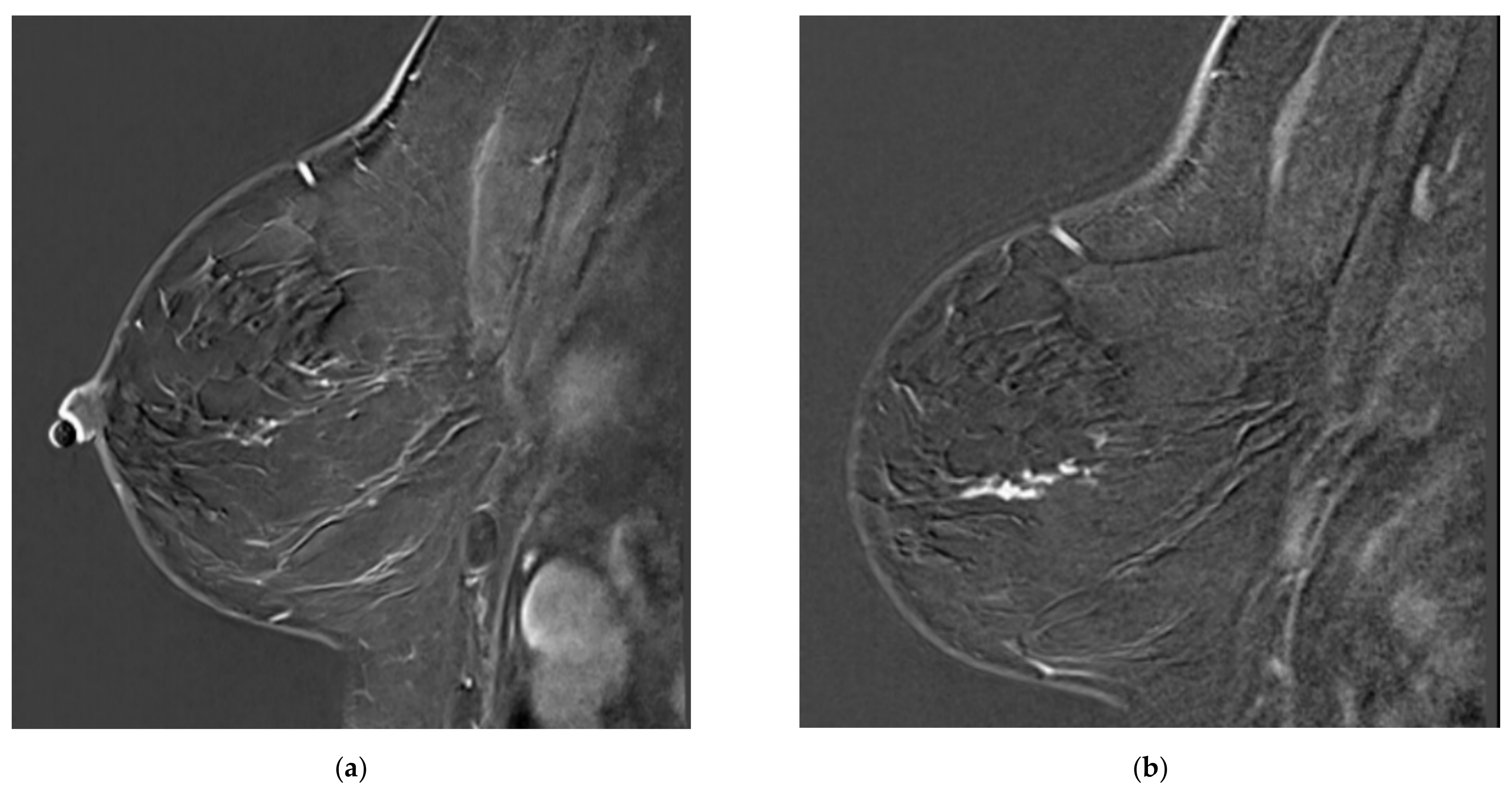 Tomography Free Full Text Missed Breast Cancers On Mri In High Risk