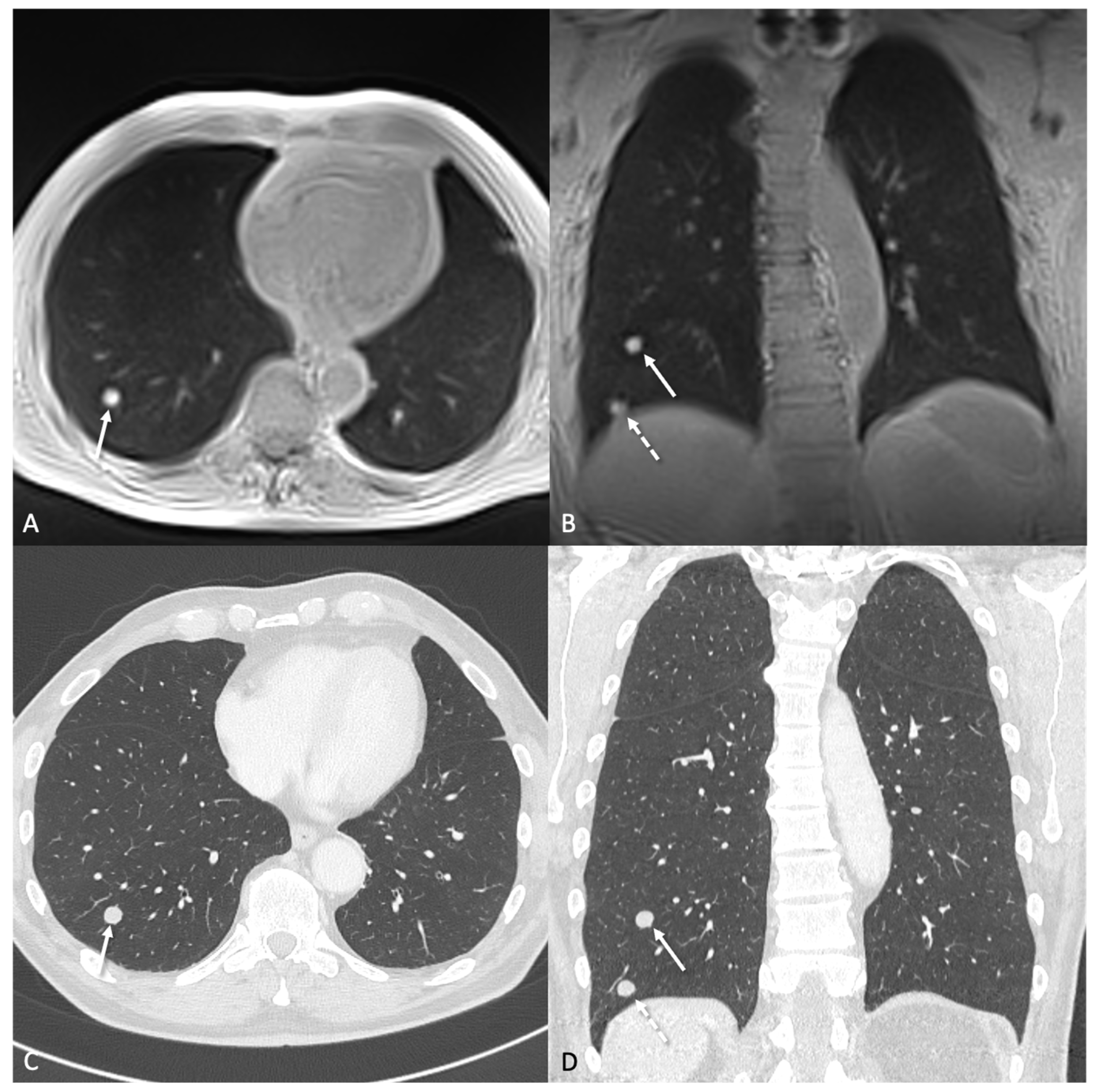 Accuracy of Ultra-Fast Low-Field MRI (0.55 T) for Lung Nodule Detection ...