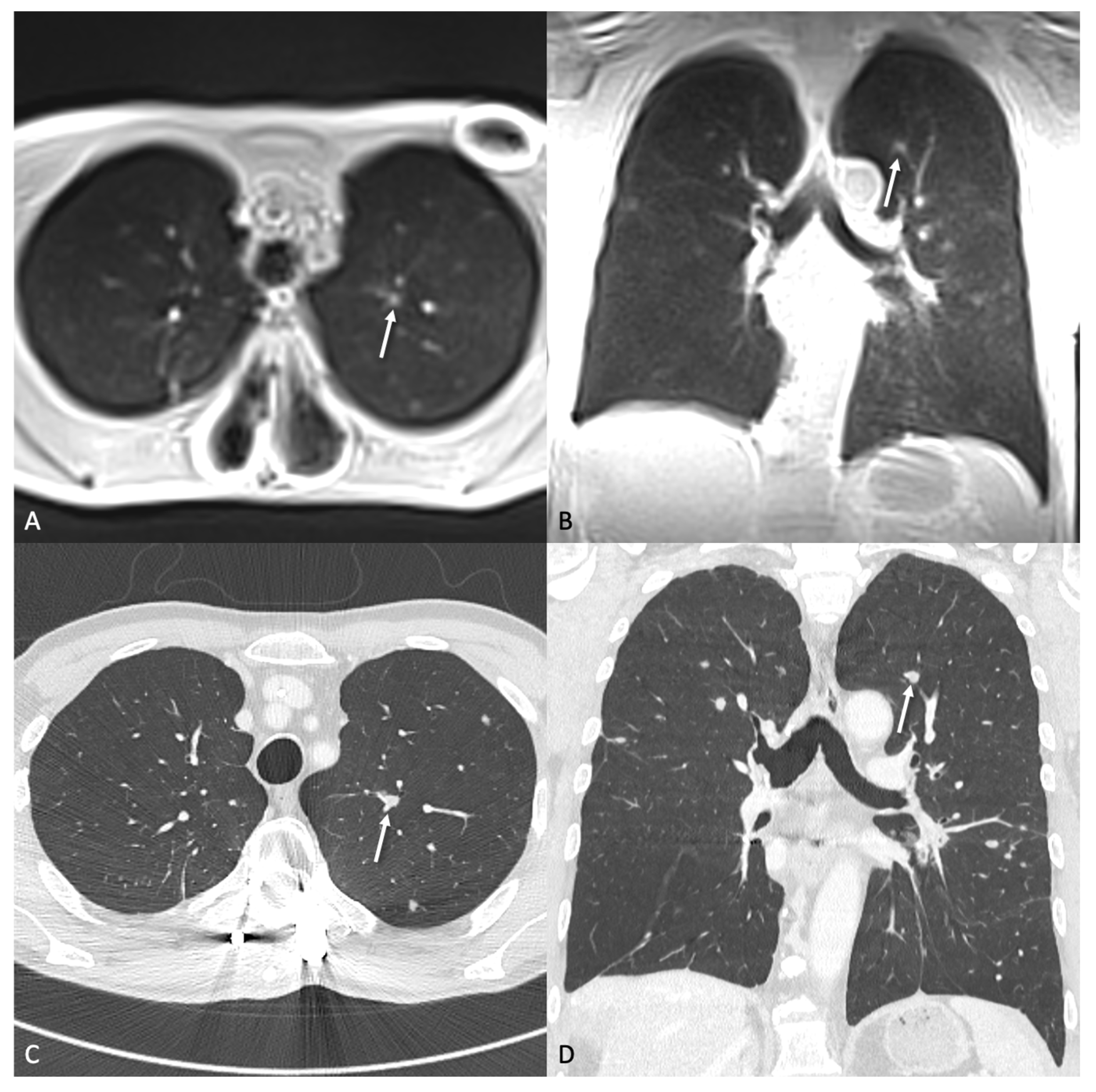 Accuracy of Ultra-Fast Low-Field MRI (0.55 T) for Lung Nodule Detection ...