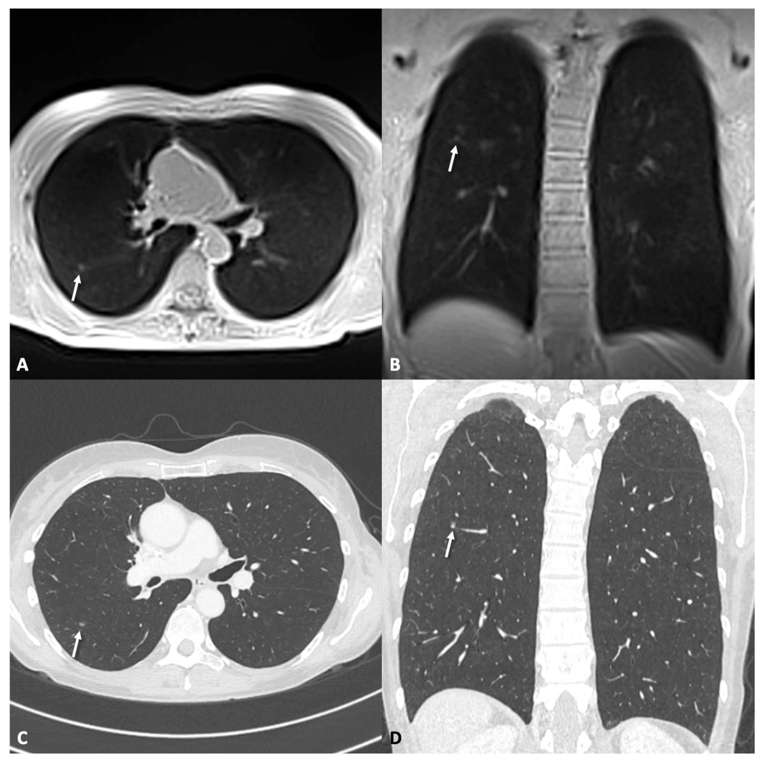 Accuracy of Ultra-Fast Low-Field MRI (0.55 T) for Lung Nodule Detection ...