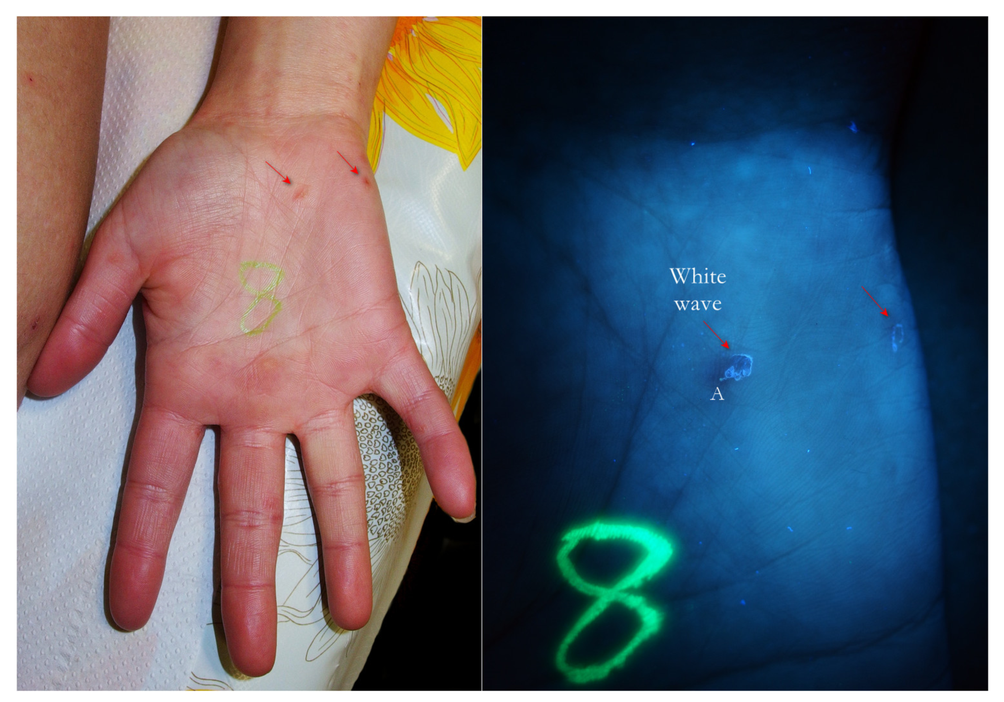 TropicalMed | Free Full-Text | in the Clinical Diagnosis Human Scabies through the Use of Ultraviolet Light (UV-Scab Scanning): Case-Series Study