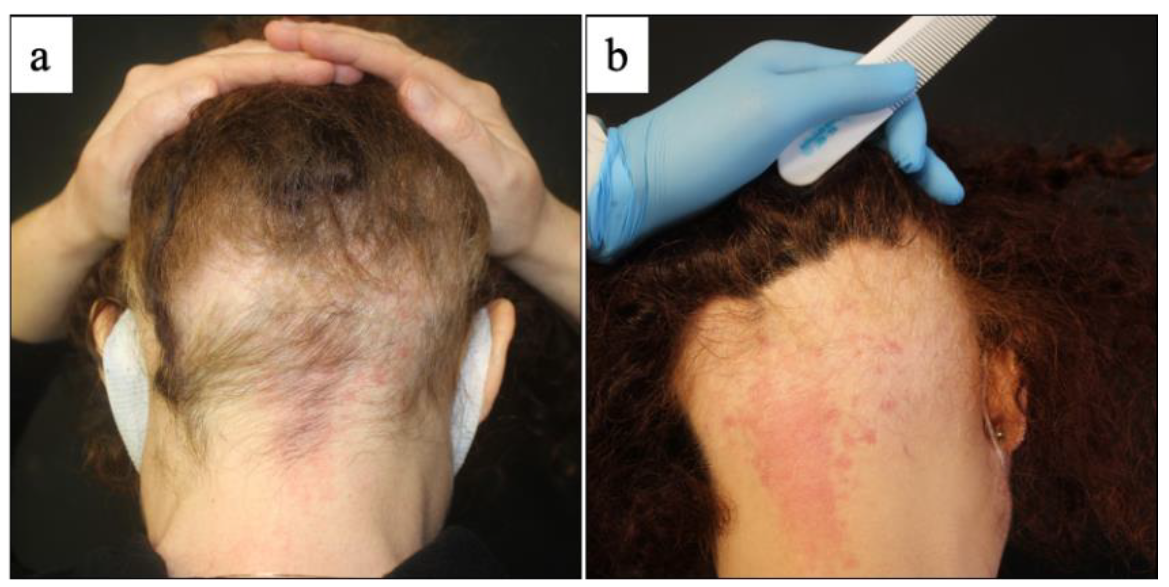 Does Steroids Or Minoxidil Cause Many Side Effects In Alopecia Areata? |  Lybrate