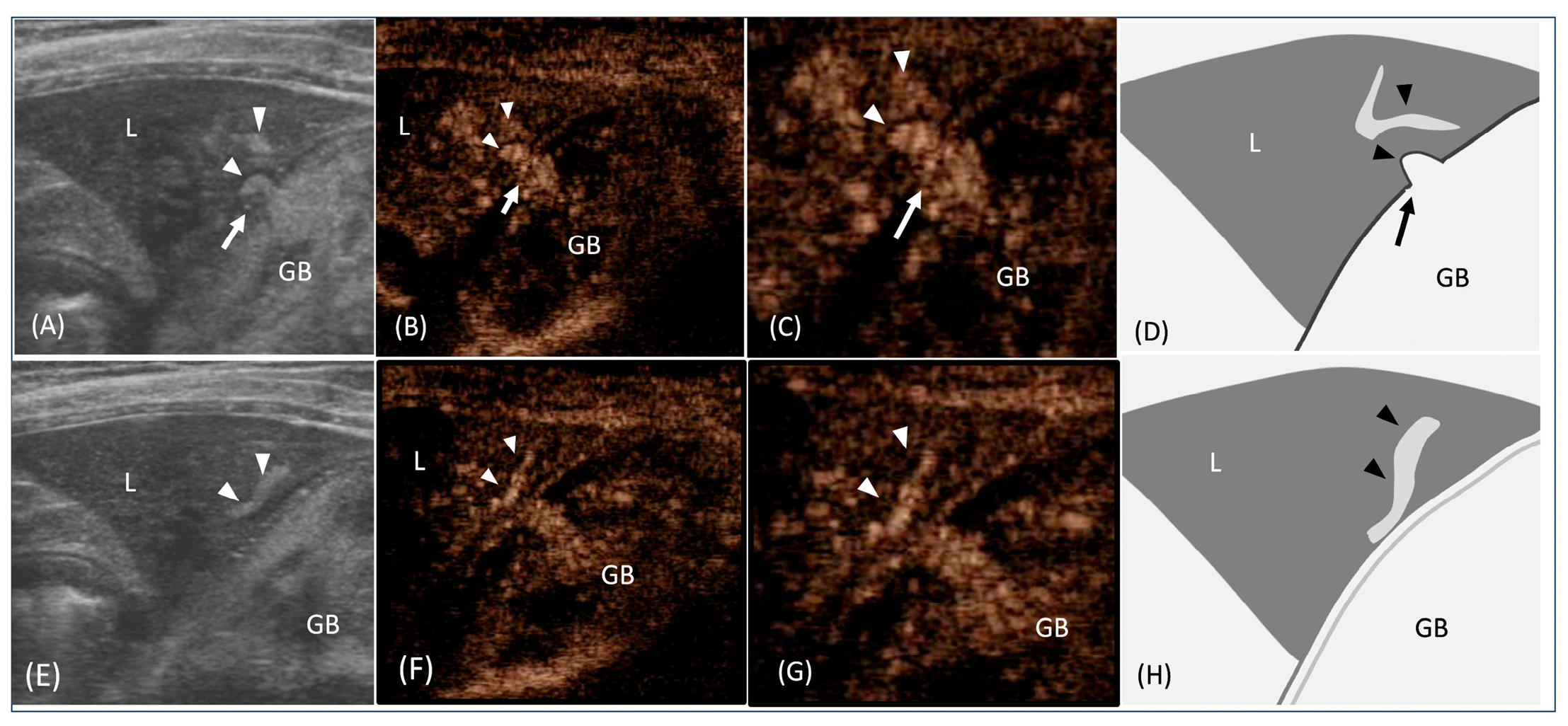 Gall Bladder Rapture Contrast-Enhanced Ultrasonography of Cholecystohepatic Communication ...