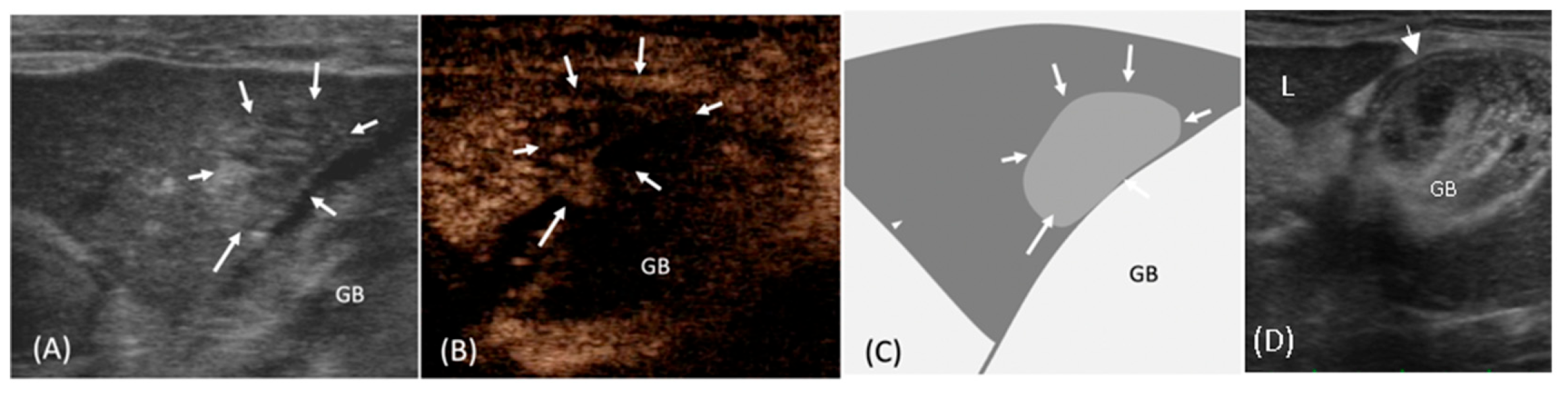 Gall Bladder Rapture Contrast-Enhanced Ultrasonography of Cholecystohepatic Communication ...