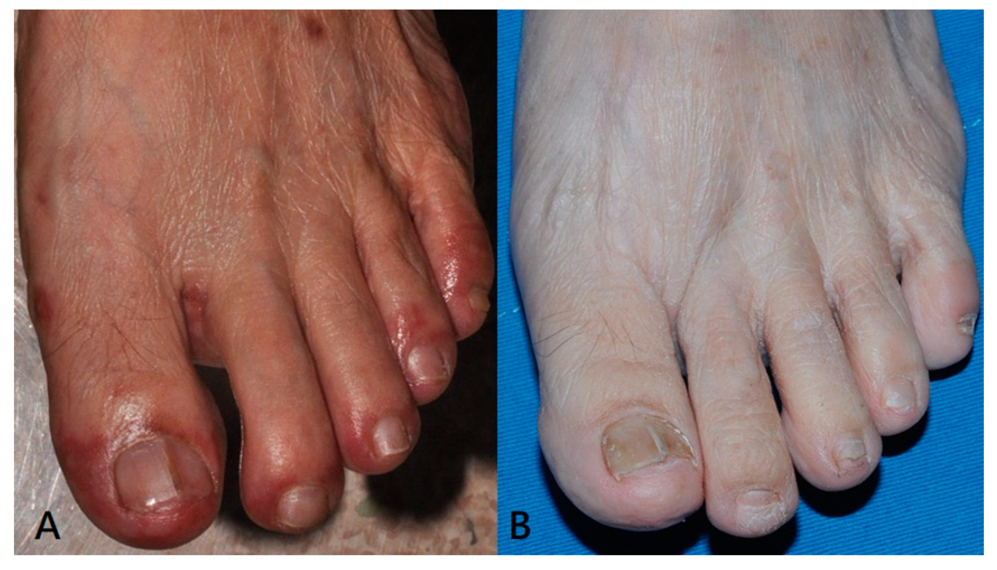 Transverse groove of nail plate (Beau line) and longitudinal melanonychia