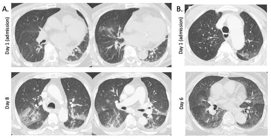 Viruses | Free Full-Text | Associations between Chest CT Abnormalities ...