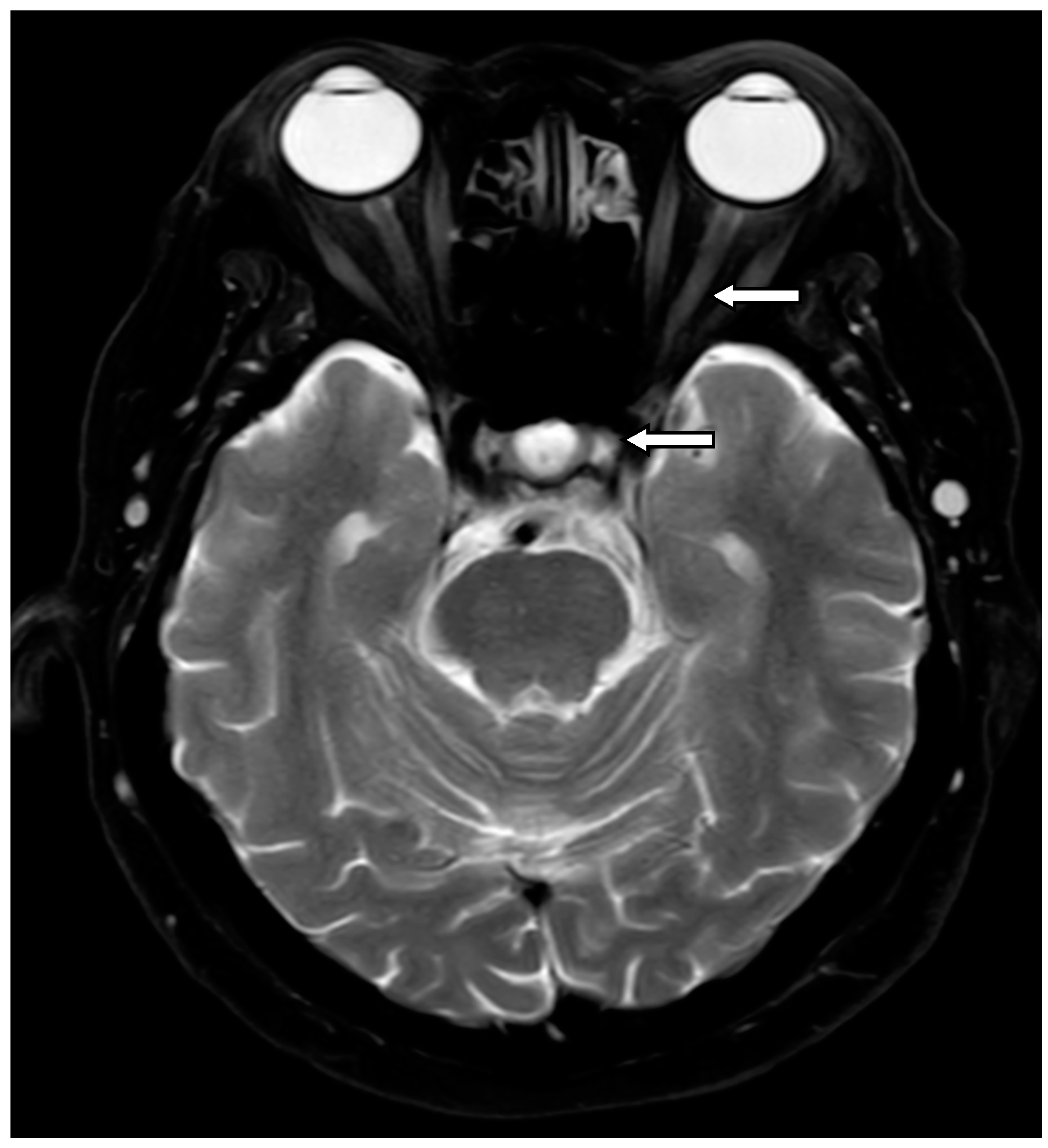 Vision Free Full Text A 10 Year Single Center Study Of The Clinical 