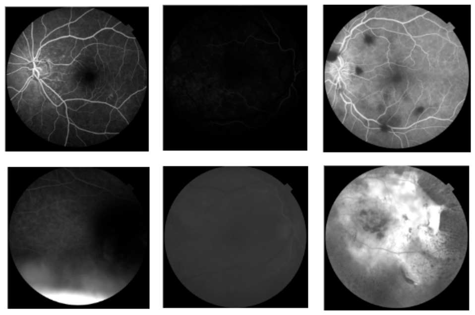 Advancing AMD Detection: Dataset Design and Deep Learning Optimization ...